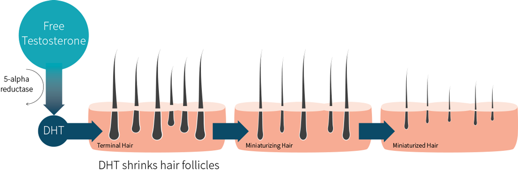 What Is DHT Hair Loss  Causes  Treatments